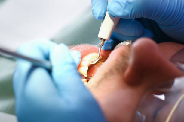 Best Emergency Wisdom Teeth Removal in Dodge City, KS